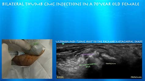 cmc thumb joint ultrasound